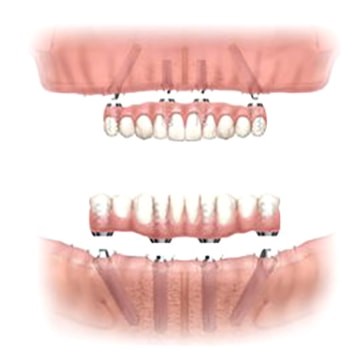 Upper Dentures Without Palate Oxford KS 67119